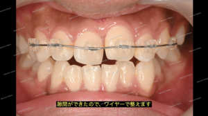 部分矯正による歯のガタガタ、反対咬合（叢生）治療で、隙間ができたのでワイヤーで並べていきます。